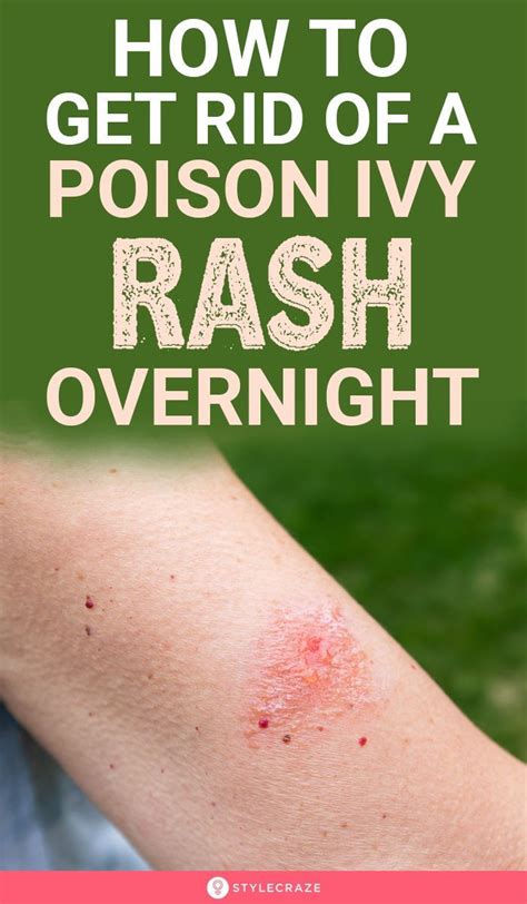 How can I get rid of poison ivy overnight?