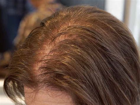 How can I hide my thinning crown?