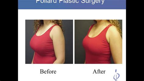 How can I lift my breasts without surgery?