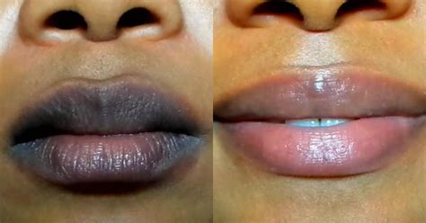 How can I lighten my smokers lips fast?