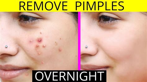 How can I make my acne less noticeable?