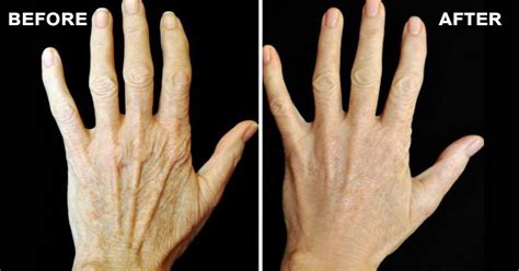 How can I make my hands look younger?