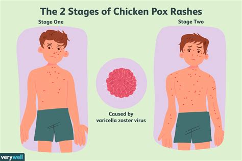 How can I prevent chicken pox early?