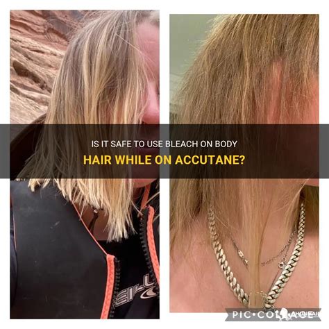 How can I protect my hair while on Accutane?