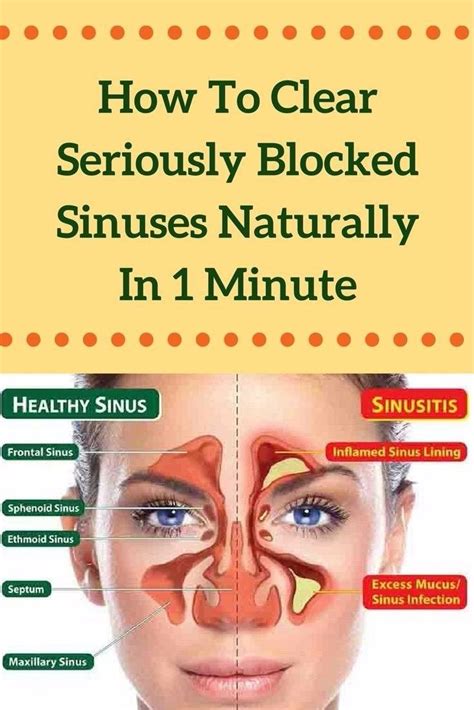 How can I recover from sinusitis fast?