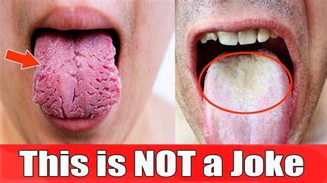 How can I recover my white tongue?