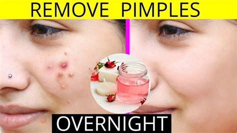 How can I reduce acne in 1 hour?