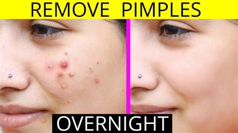 How can I reduce the size of a pimple naturally?