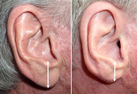How can I reduce the size of my earlobe?