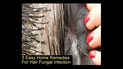 How can I regrow my hair after fungal infection?