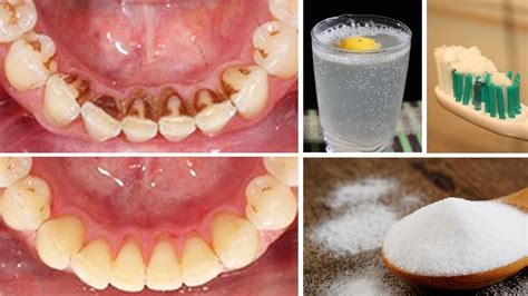How can I remove bacteria from my teeth at home?