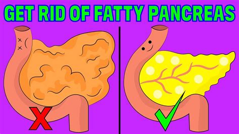 How can I remove fat from my pancreas naturally?
