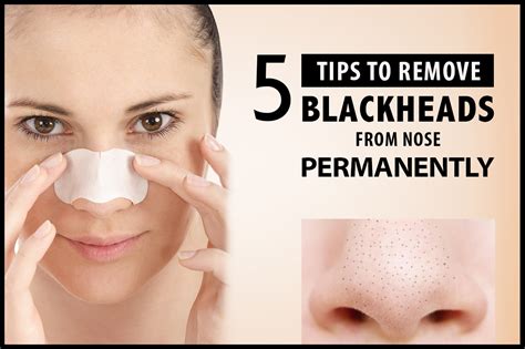 How can I remove my blackheads permanently?