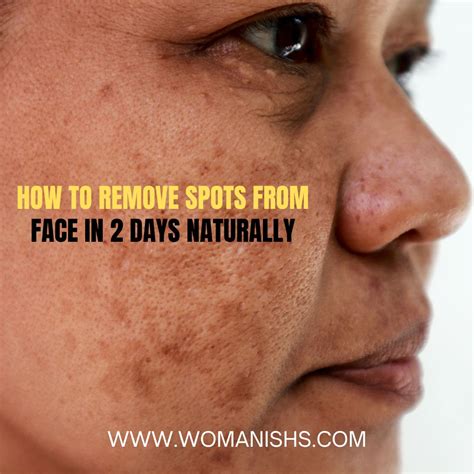 How can I remove spots from my face in 2 days naturally?