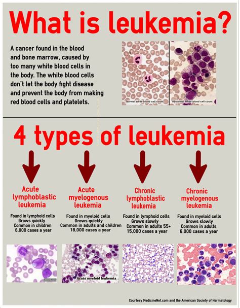 How can I rule out leukemia?