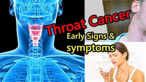 How can I rule out throat cancer?