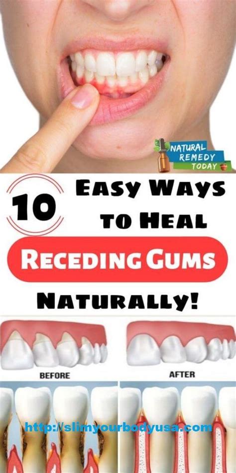 How can I shrink my gum pocket at home?