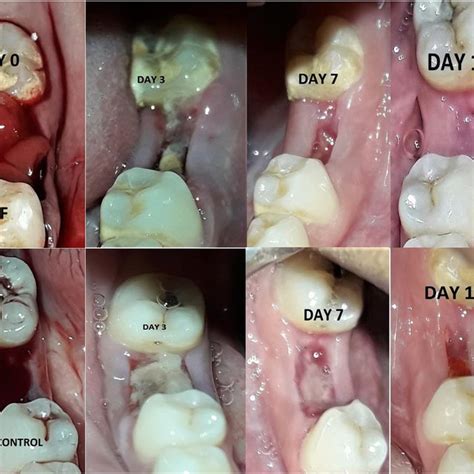 How can I speed up gum healing after tooth extraction?