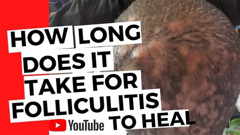 How can I speed up the healing of folliculitis?