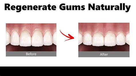 How can I stimulate my gums to regenerate?