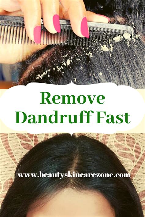 How can I stop dandruff fast?