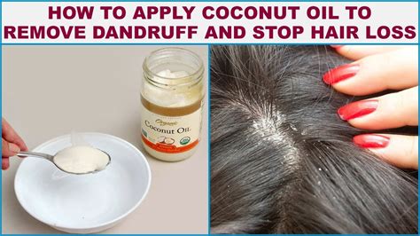 How can I stop dandruff naturally?