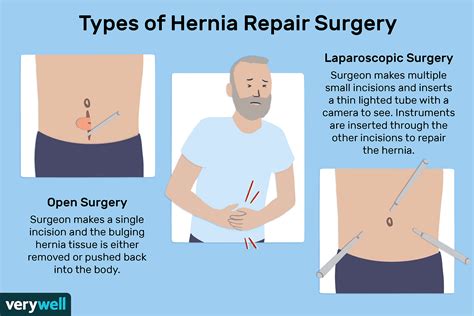 How can I stop my hernia from progressing?