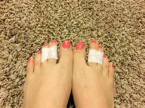 How can I straighten my toes at home?