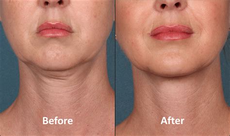 How can I tighten my face without Botox?