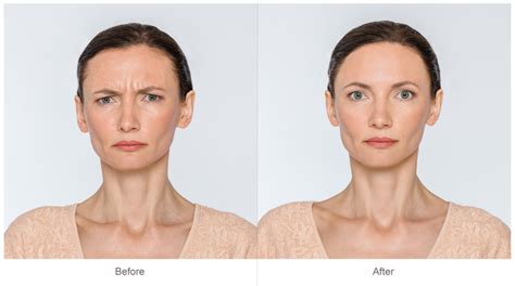How can you tell if someone has Botox?