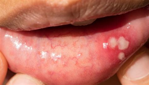 How can you tell the difference between mouth sores and cancer?