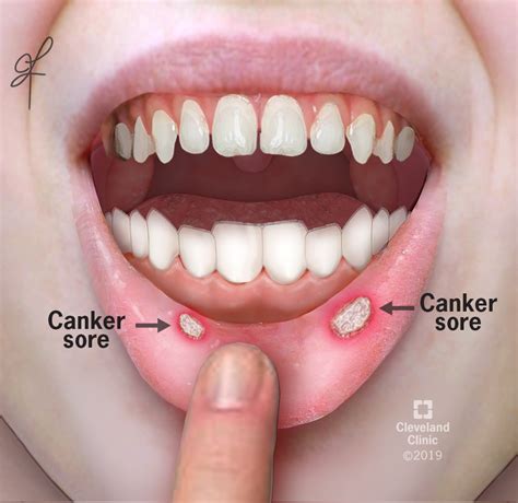 How can you tell the difference between oral cancer and canker sores?