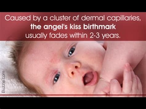 How common are angel kisses?
