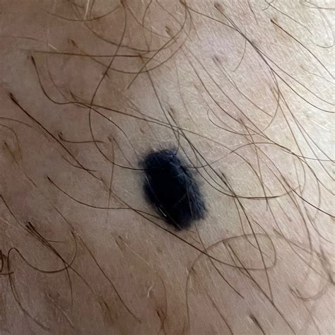 How common is a blue mole?