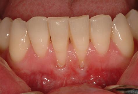 How common is gum recession in 30s?