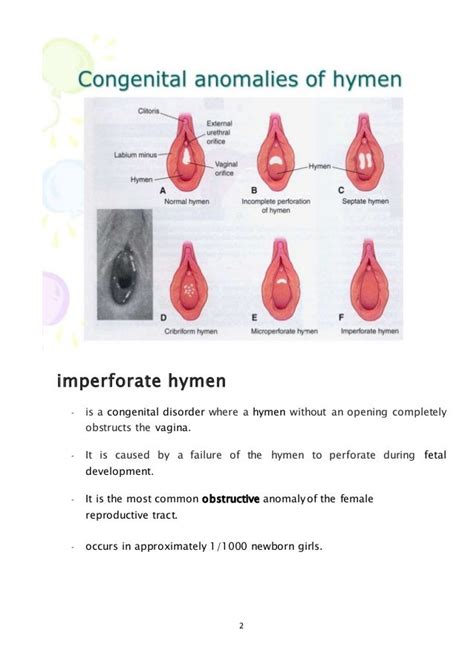 How common is imperforate hymen?