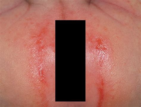How common is pad rash?