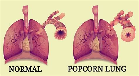How common is popcorn lung?