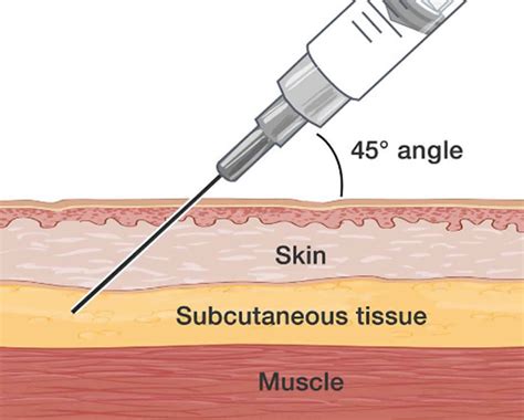 How deep should a subcutaneous injection be?