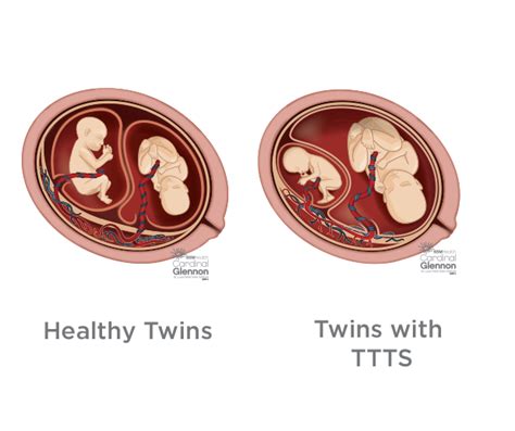 How did I eat my twin?