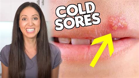How did I get a cold sore if I didn't kiss anyone?