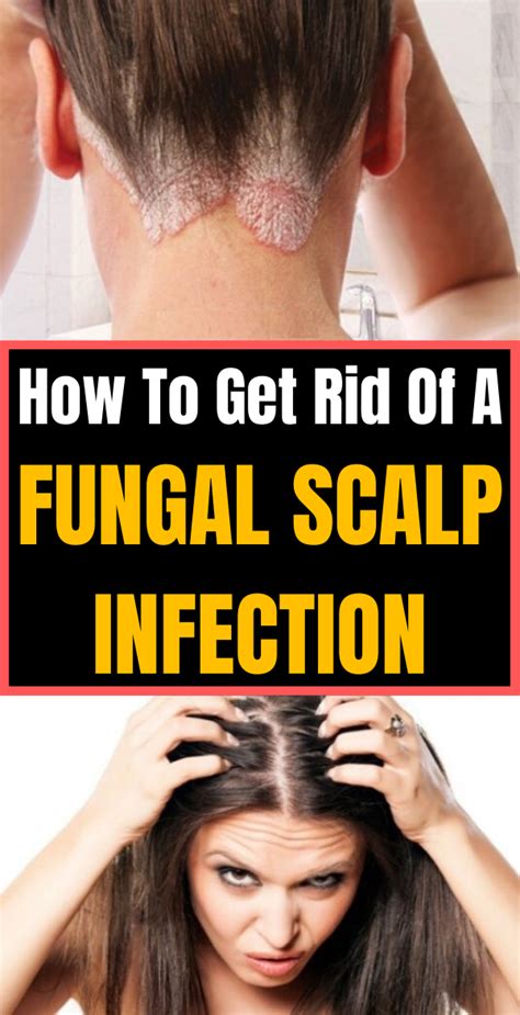 How did I get a fungal infection on my scalp?