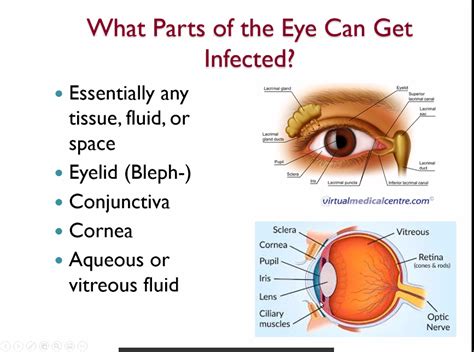 How did I get an eye infection?