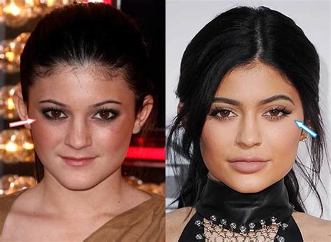 How did Kylie Jenner get rid of her hooded eyes?