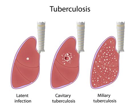 How did TB start?