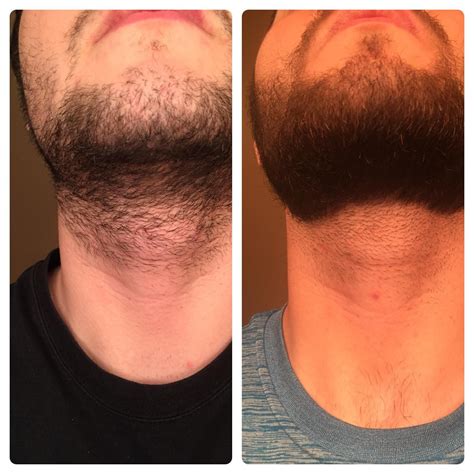How do I fix my patchy beard at 17?
