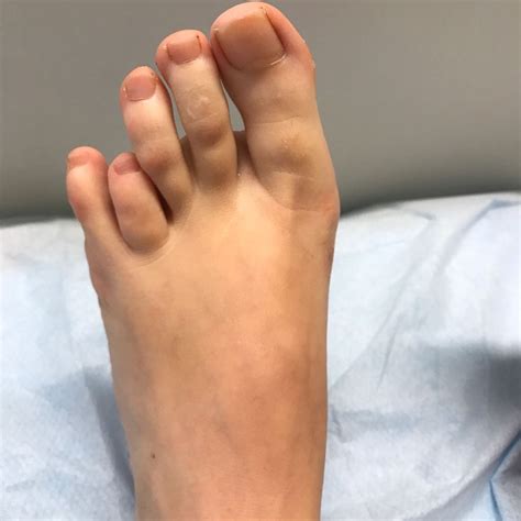 How do I fix my second toe longer?