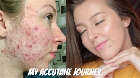 How do I get enough fat on Accutane?