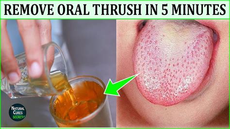 How do I get instant relief from oral thrush?