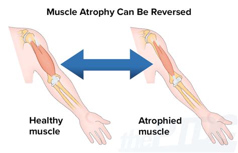 How do I get my muscles back after atrophy?
